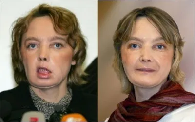 En quelle année a eu lieu la première greffe du visage en France ?