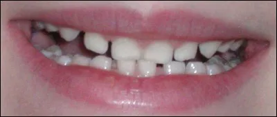 Combien de dents de lait contient la bouche d'un enfant ?