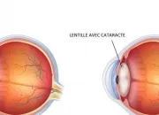 Quiz La cataracte