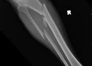 Quiz Fractures de jambe