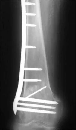 Par rapport  la lame plaque  angle fixe avec vis bicorticales non verrouillables, CLASSIQUE, quel serait l'avantage de ce montage par plaque verrouille par vis UNIcorticales pour cette fracture ?