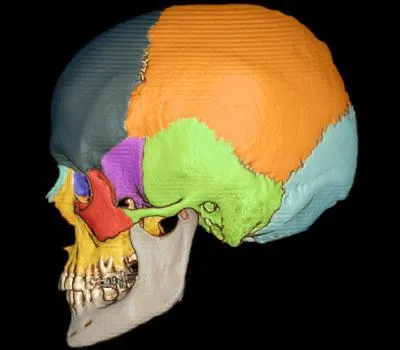 Le premier crne imprim en 3 D a t implant avec succs sur une patiente de 22 ans.