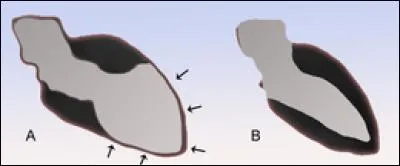 Le syndrome de tako-tsubo, ou encore appelé syndrome des curs brisés, est une cardiomyopathie consistant en une sidération myocardique qui survient après :